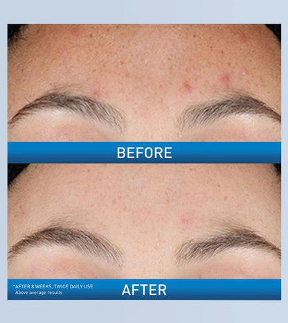 CeraVe Resurfacing Retinol Serum For Face with Niacinamide