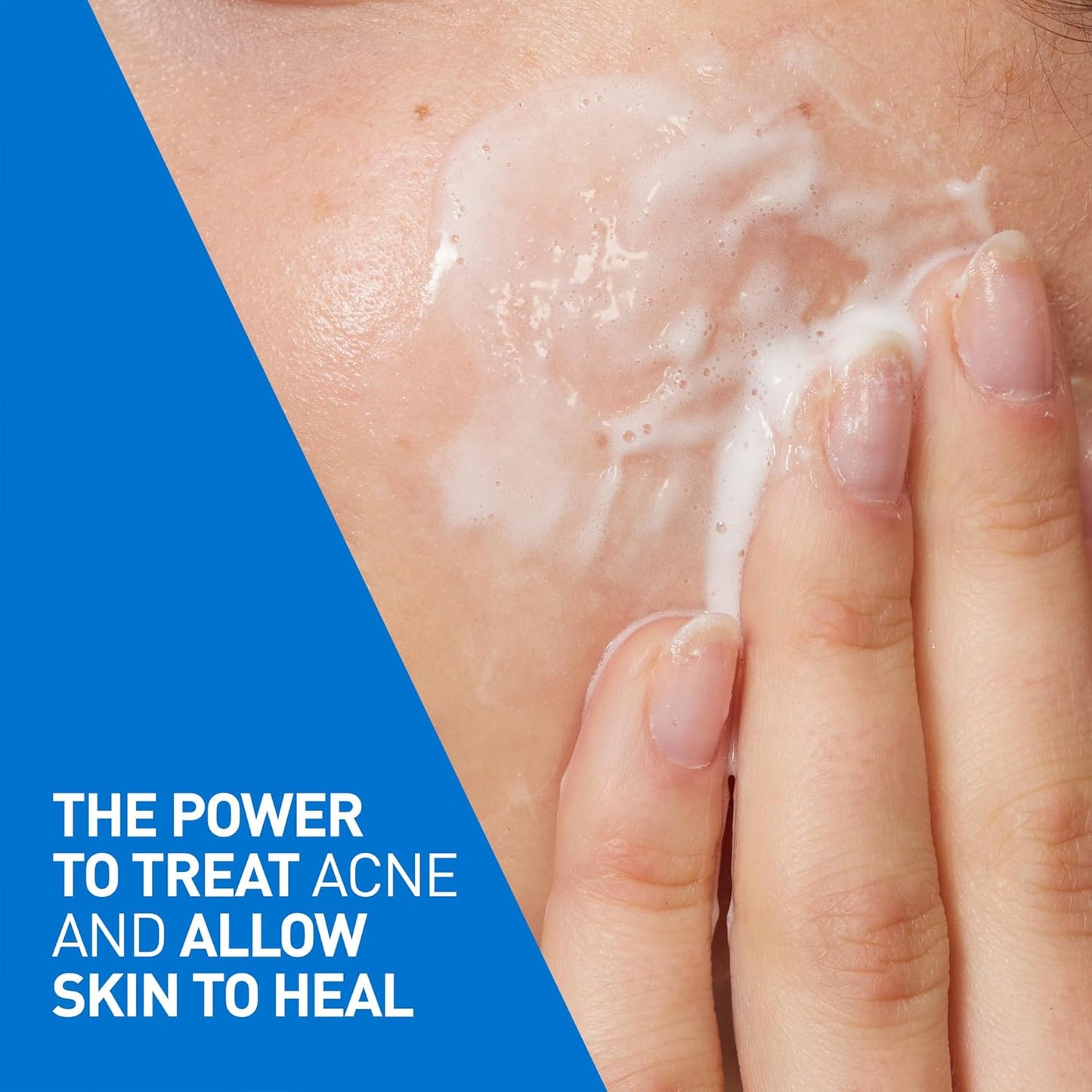 CeraVe 4% Benzoyl Peroxide Acne Treatment Foaming Cleanser Face & Body Wash