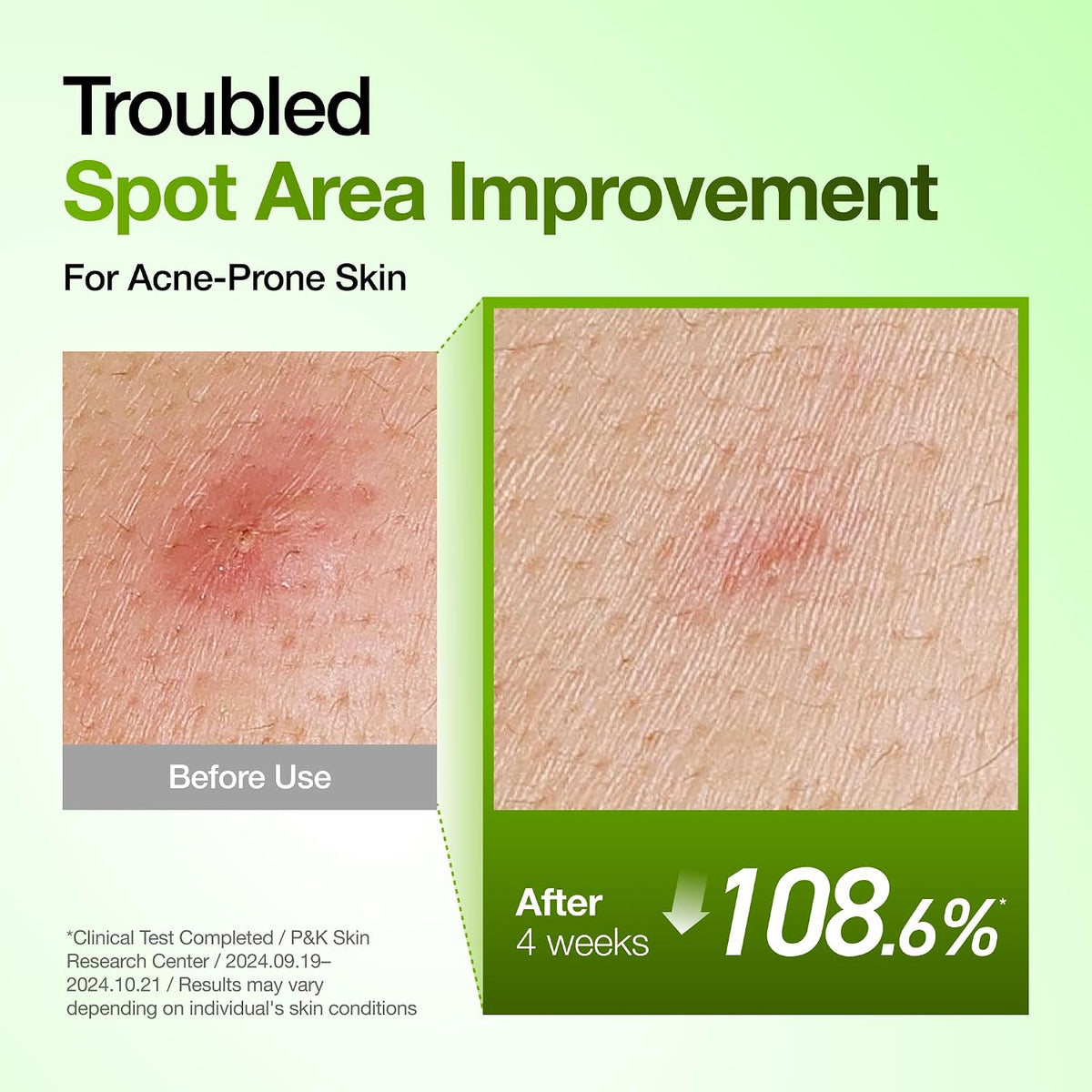 Anua Azelaic Acid 10 Hyaluron Redness Soothing Serum- (30ml/ 1.01 fl oz.)