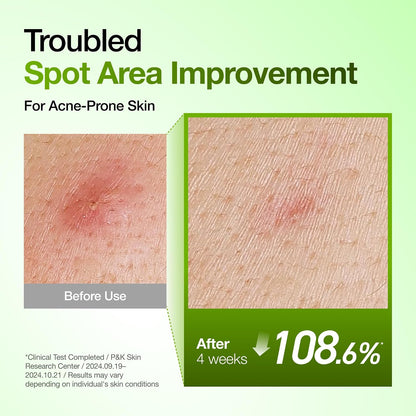 Anua Azelaic Acid 10 Hyaluron Redness Soothing Serum- (30ml/ 1.01 fl oz.)